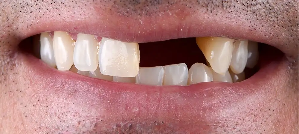 broken tooth before