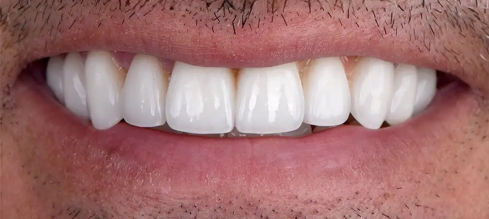 broken tooth after
