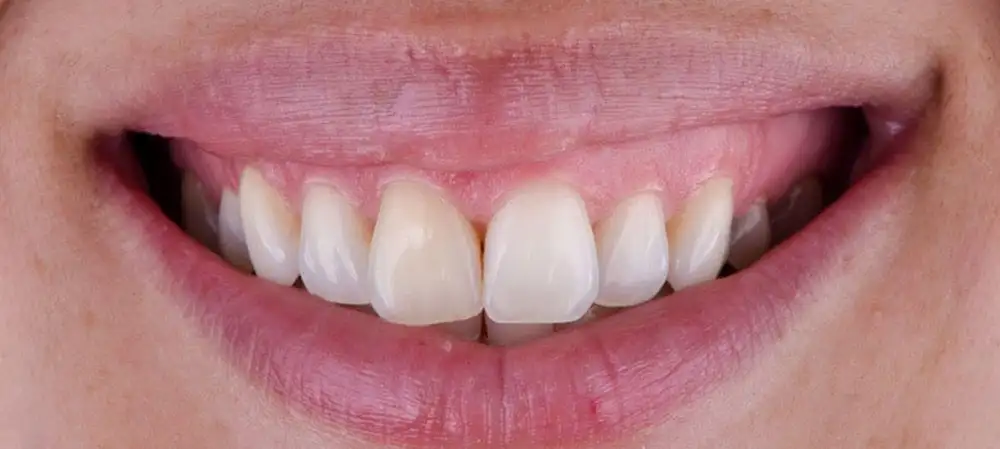 Cagigas dental before and after smile