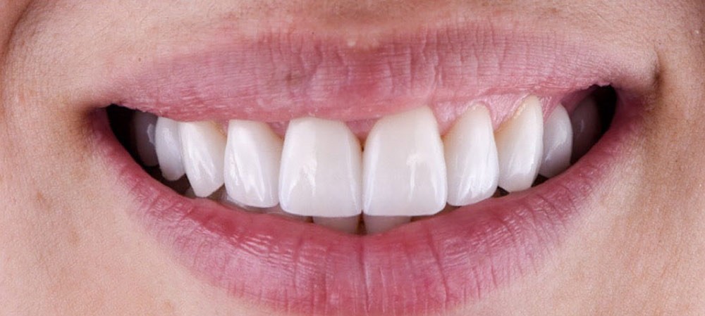 Cagigas dental before and after smile