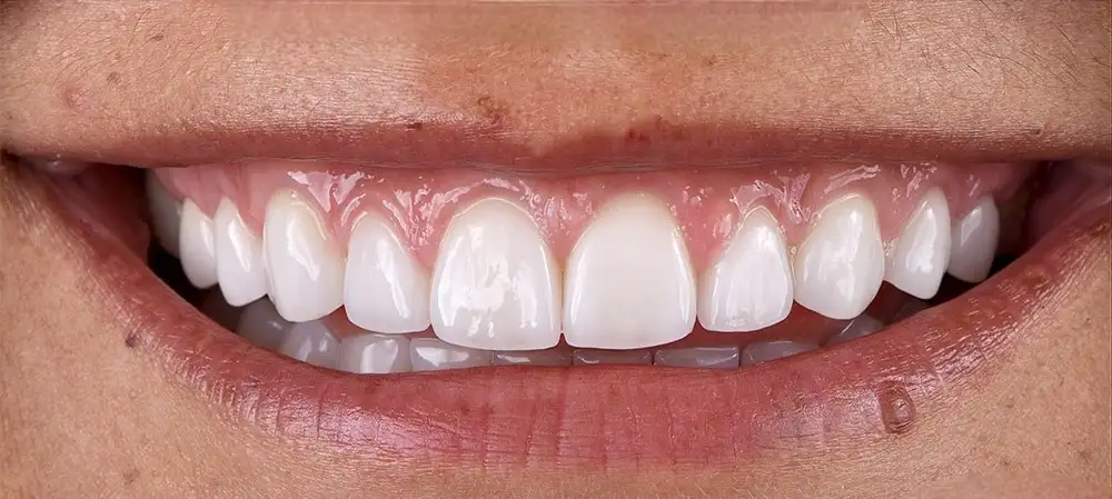 veneers smile after