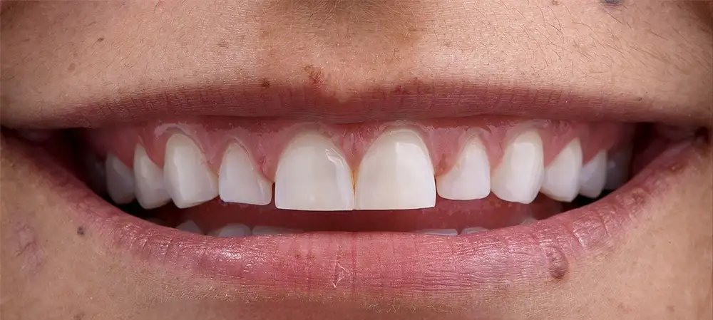 veneers smile before