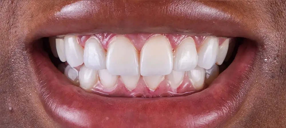 braces smile after